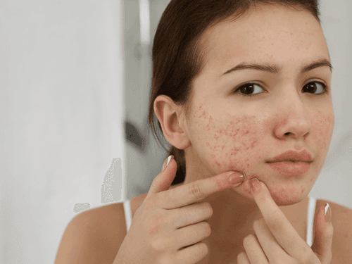 CBD no tratamento contra a insônia e a acne