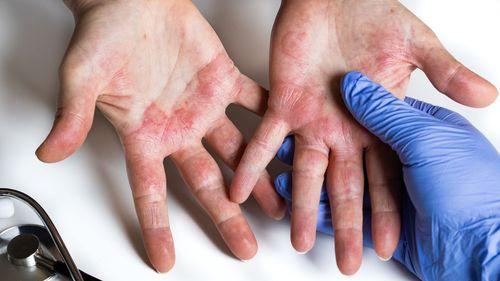 La cannabis puede ayudar en el tratamiento de la dermatitis atópica