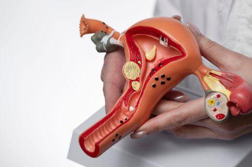 Endometriose