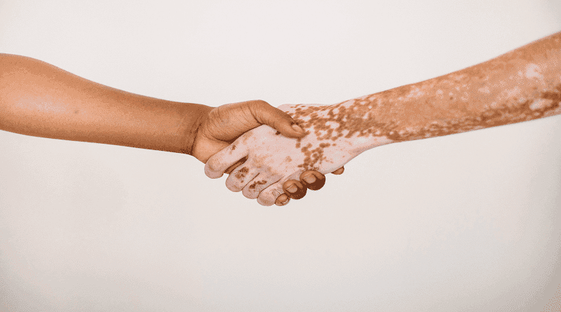 Canabinoides pode ser usado para o tratamento de vitiligo