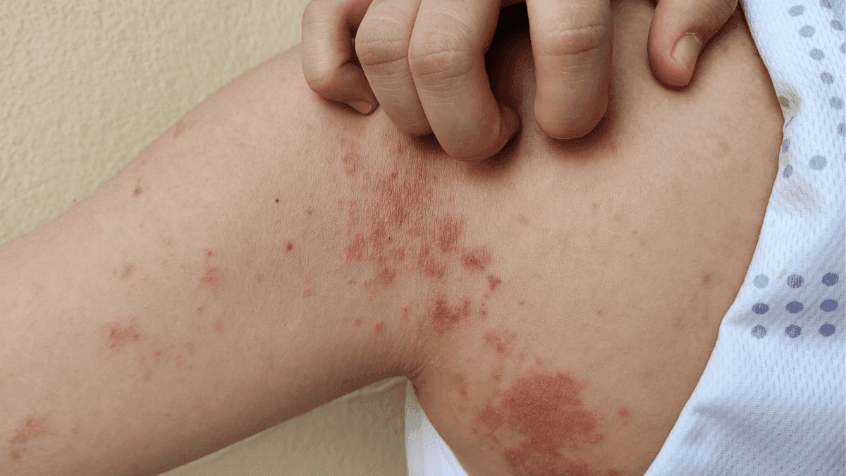 Canabinoides no tratamento da dermatite atópica: potencial terapêutico e Perspectivas