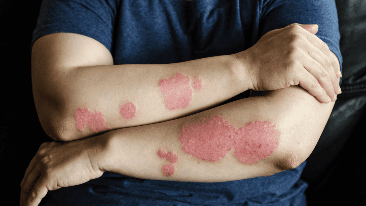 CBD na dermatologia: o papel da cannabis no tratamento de doenças de pele