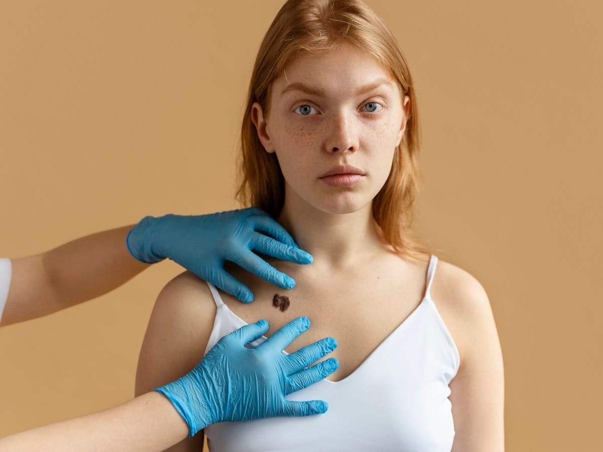 O potencial da cannabis na luta contra o melanoma: uma nova esperança no tratamento do câncer de pele