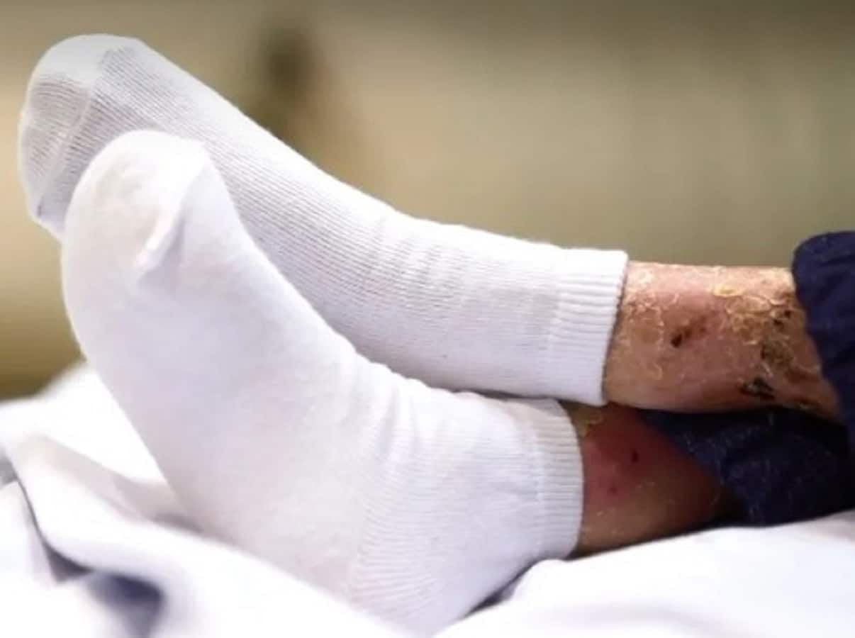 Pomada de cannabis se mostra eficaz contra Epidermólise Bolhosa