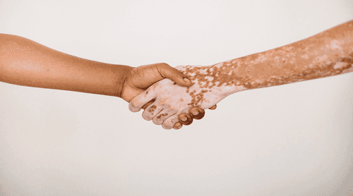 Cannabinoids can be used for the treatment of vitiligo