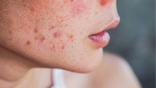 Cannabis in the Treatment of Skin Diseases: 3 Science-Backed Benefits