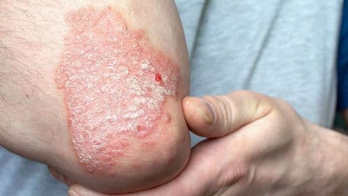 Psoríase: causas, sintomas e novos tratamentos com fitocanabinoides