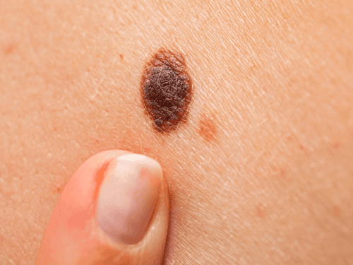 Extrato de cannabis apresenta potencial no tratamento do melanoma