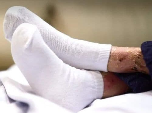 Pomada de cannabis se mostra eficaz contra Epidermólise Bolhosa